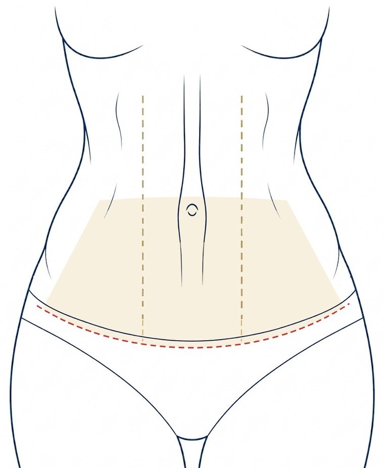 Abdomen from the front: a beige area from the navel down to a dashed red line below the top of the underwear, and two vertical gold lines beside the midline.