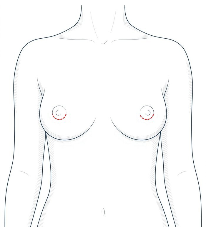 Female torso from the front with a dashed red line along the lower edge of each areola.