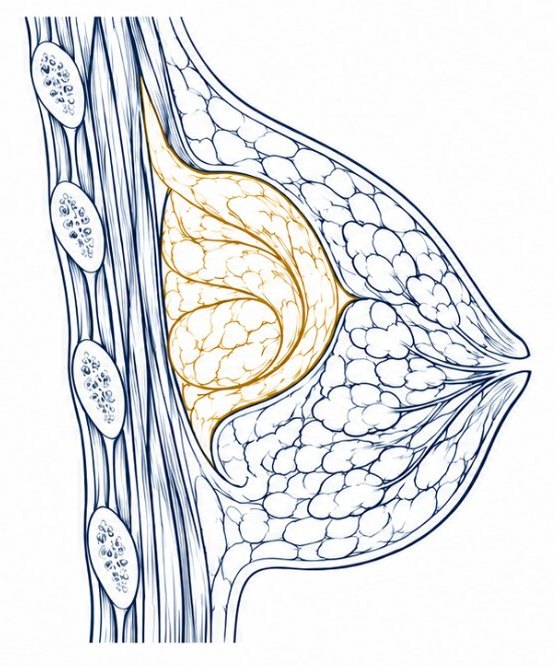The patient's own tissue folded like a fist behind the gland, projecting the breast again.